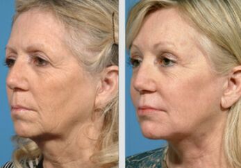 antes e despois do rexuvenecemento da pel con plasma