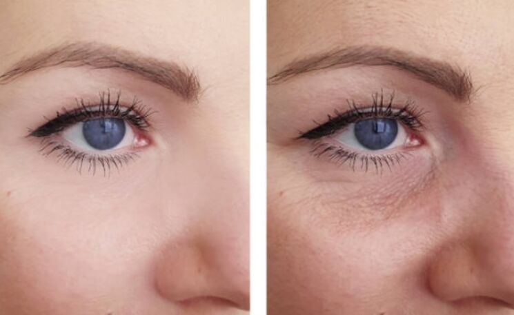 antes e despois do rexuvenecemento do plasma arredor dos ollos