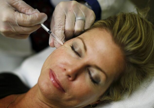 A introdución de recheos na pel da cara - un método de inxección para apertar