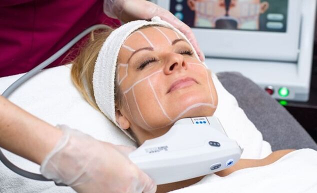 Lifting SMAS ultrasónico para lifting facial non cirúrxico