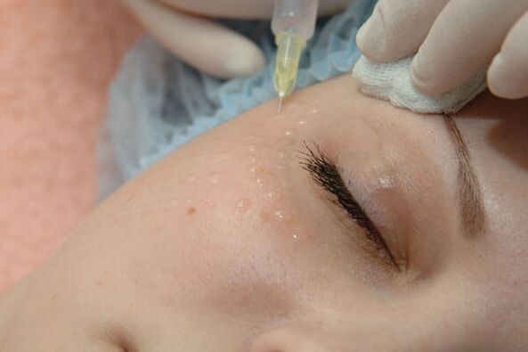Mesoterapia - un método de inxección de rexuvenecemento da pel facial