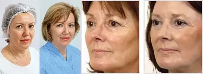 O resultado do rexuvenecemento da pel facial con láser é a redución das engurras
