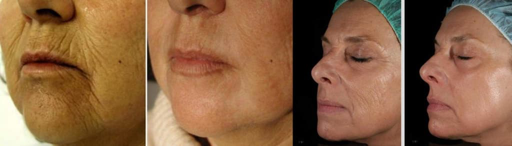 Pel facial antes e despois do procedemento de rexuvenecemento con láser