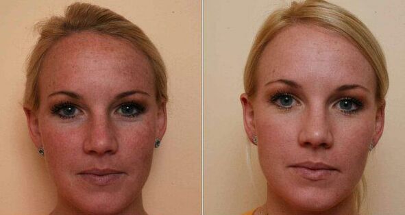 antes e despois do rexuvenecemento da pel facial con láser