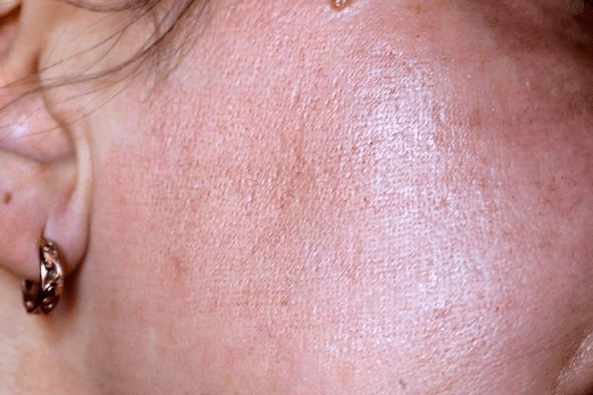 vermelhidão da pel despois do rexuvenecemento con láser