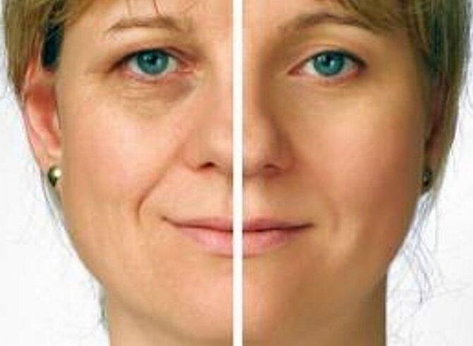 pel arredor dos ollos antes e despois do rexuvenecemento